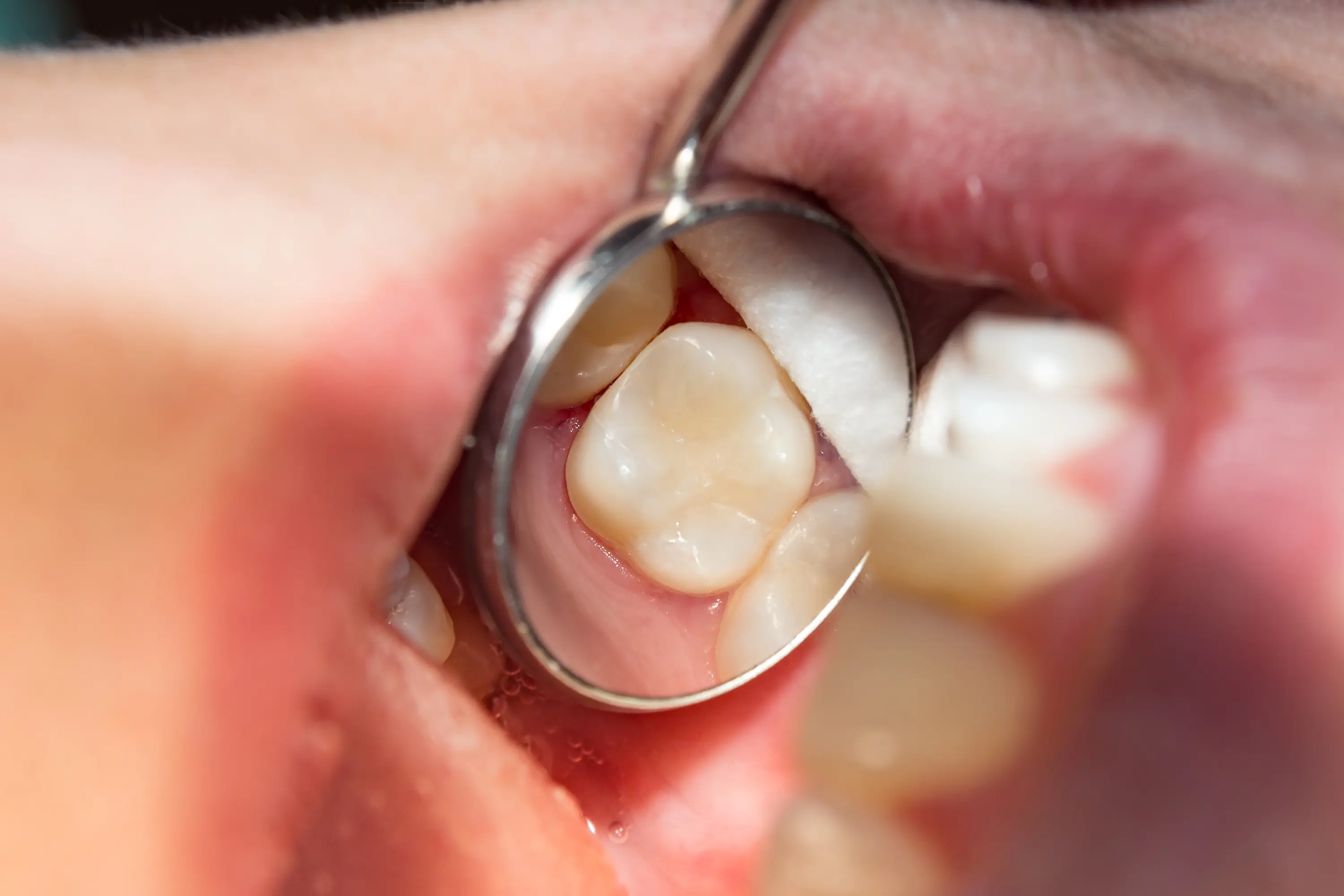 Porcelain Crowns and Fillings- Cosmetic Dentist in Sacramento, CA - Ideal Dentistry