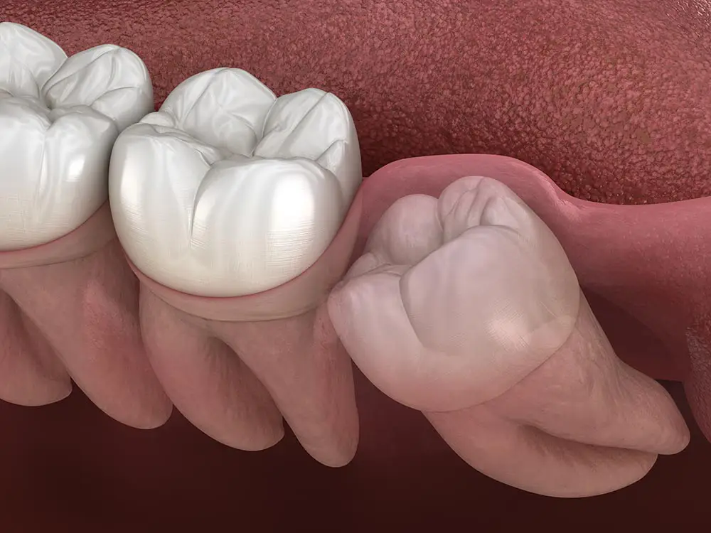 Wisdom Tooth Removal in Sacramento - Ideal Dentistry