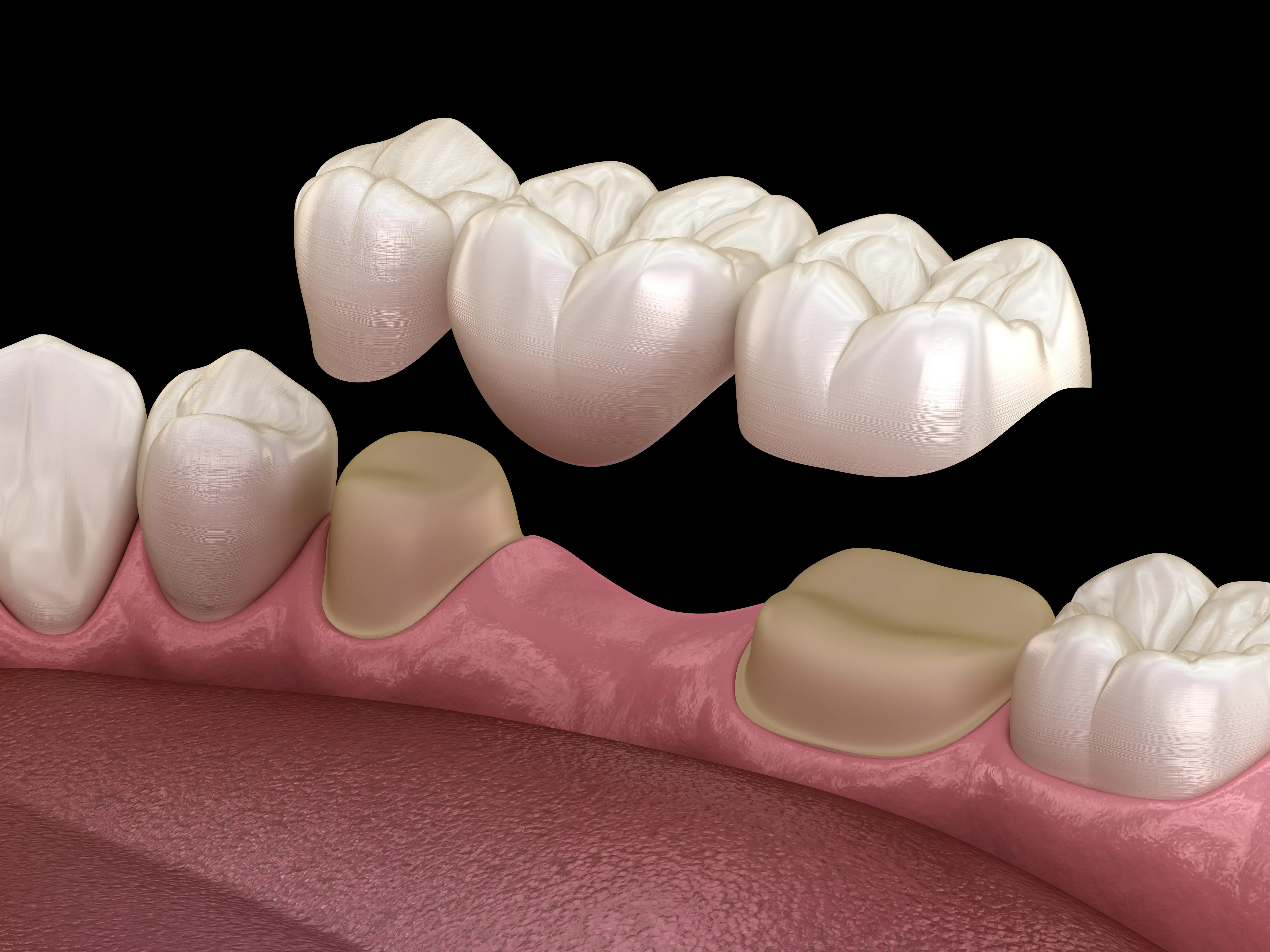 Fixed Bridges - Restorative Dentistry in Sacramento - Ideal Dentistry